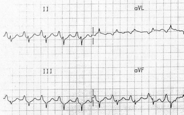 P10 - p-pulmonale-3-590x369