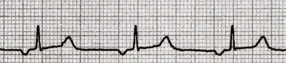 Ektopik atriyal ritim Kaynak: lifeinthefastlane.com - ecg library