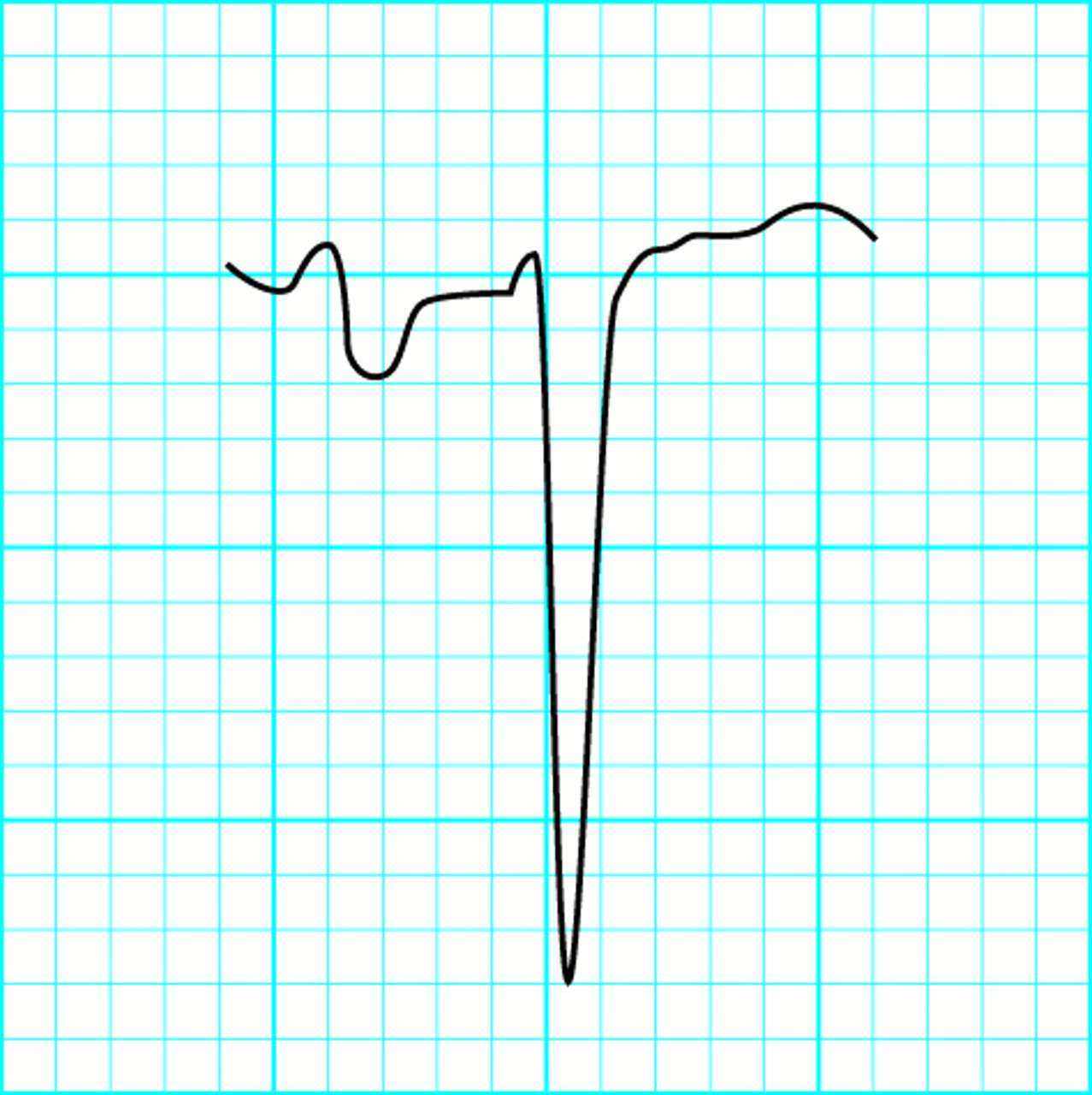 ABC of clinical electrocardiography:  Conditions affecting the left side of the heart. BMJ 2002;324:1264.1