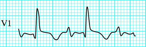 ABC of clinical electrocardiography:  Conditions affecting the right side of the heart. BMJ 2002;324:1201