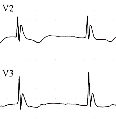 Tipik Osborn Dalgaları Kaynak : lifeinthefastlane.com - ECG library