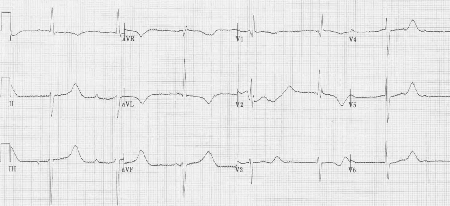 Ciddi hipotermiye bağlı uzamış QTc (620 ms). Kaynak : lifeinthefastlane.com - ECG library