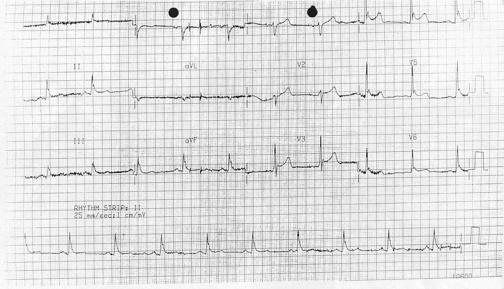 Hipotermili hastada titreme artefaktı (ayrıca Osborn dalgalarına da dikkat ediniz) Kaynak : lifeinthefastlane.com - ECG library