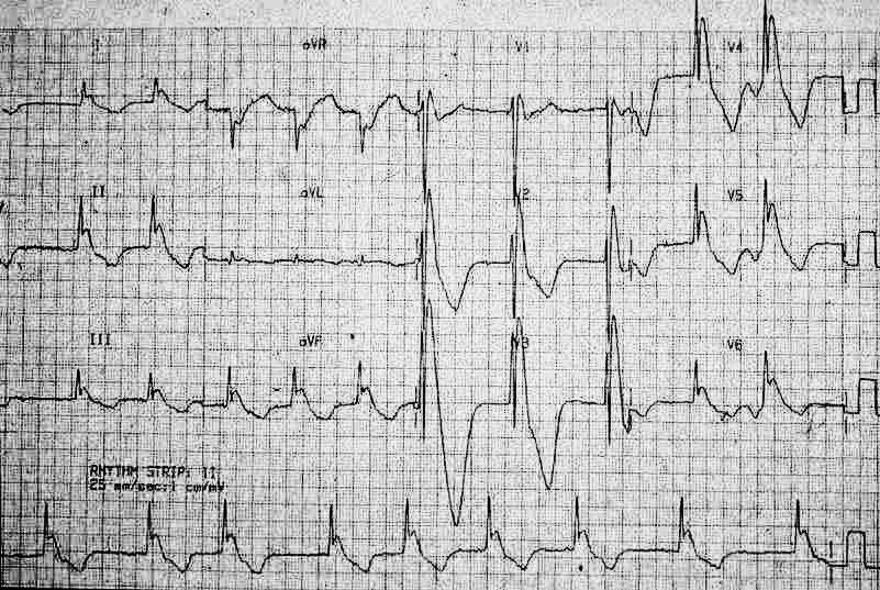 Ciddi hipotermide belirgin Osborn dalgaları. Kaynak : lifeinthefastlane.com - ECG library