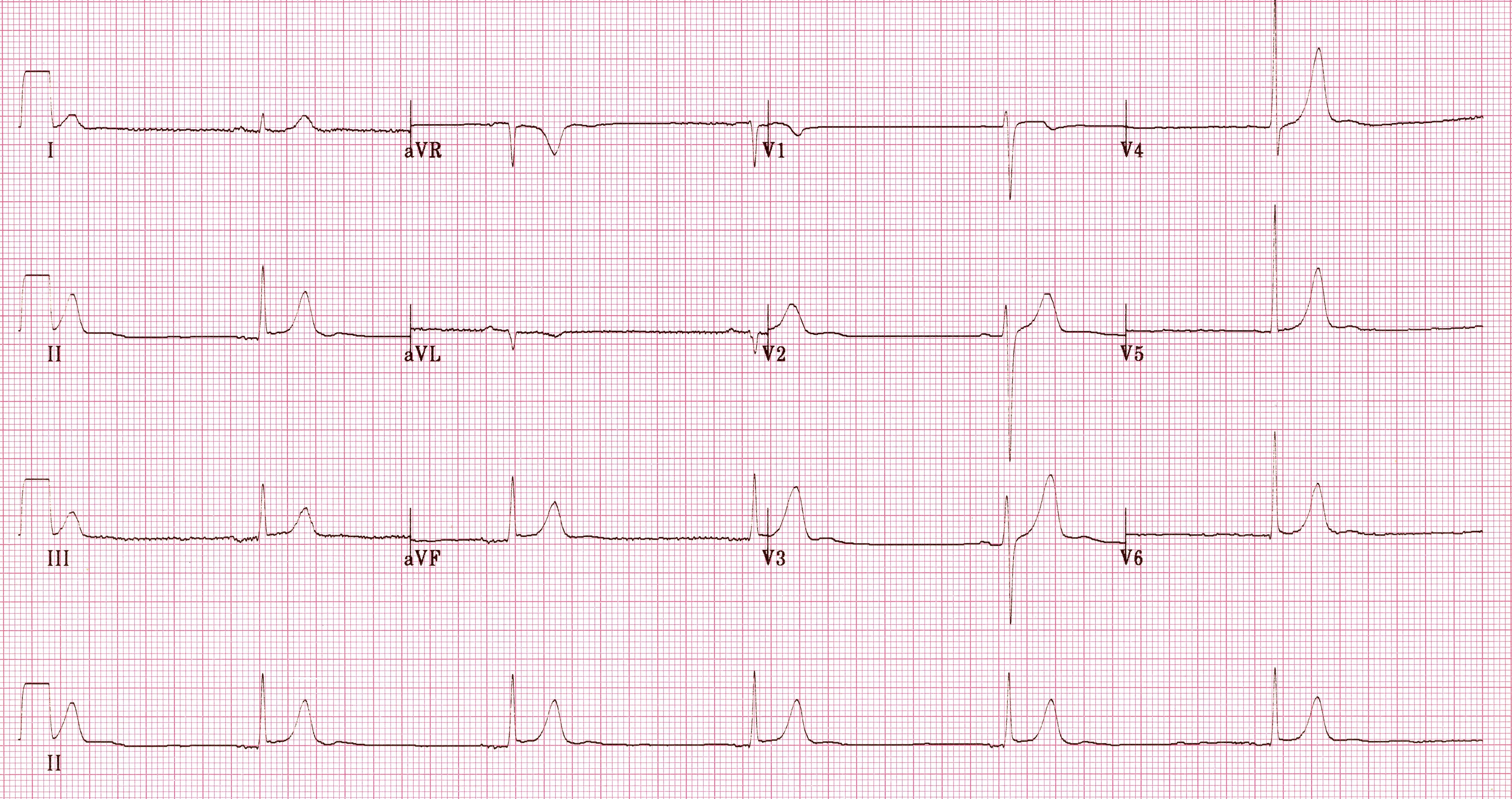 Hipotermiye ikincil belirgin sinüs bradikardisi (30 vuru/dak). Kaynak : lifeinthefastlane.com - ECG library