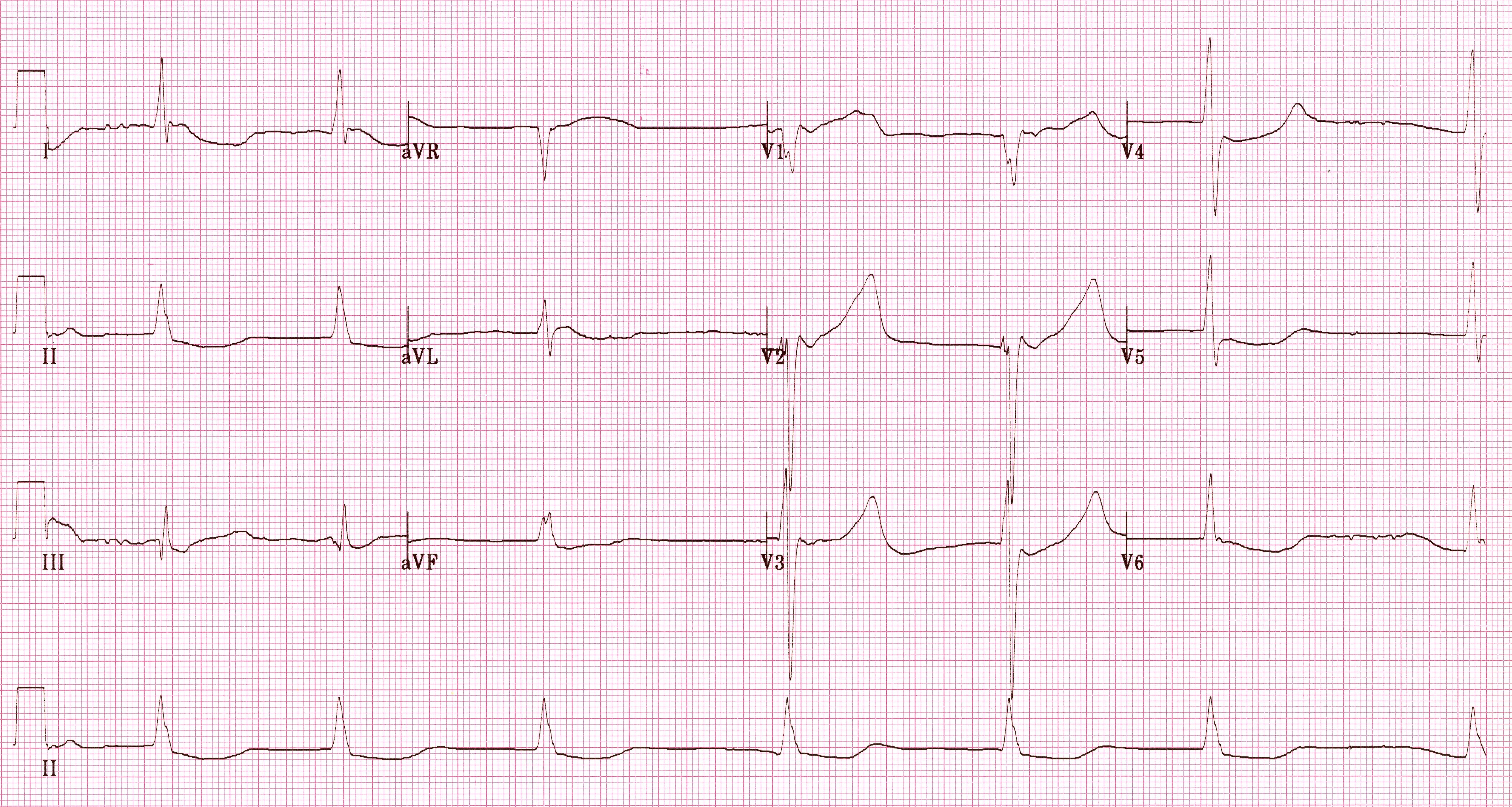 Hipotermiye bağlı yavaş ventrikül yanıtlı atriyal fibrilasyon. Kaynak : lifeinthefastlane.com - ECG library