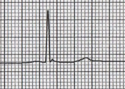 Hafif hipotermide ince Osborn dalgaları (sıcaklık 32.5 C) Kaynak : lifeinthefastlane.com - ECG library