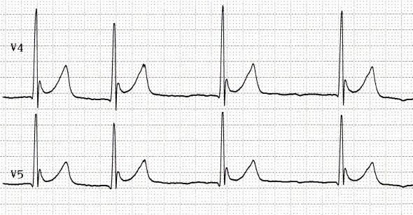 Orta derece hipotermide J dalgaları (30 C) Kaynak : lifeinthefastlane.com - ECG library