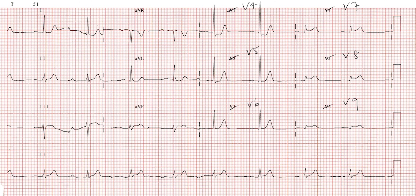 posterior-stemi-acilci-net