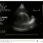 Ciddi perikardiyal efüzyon ve sağ ventrikül diastolik kollaps sonoguide.com