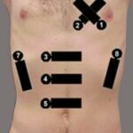 Hipotansif hasta protokolü. 1-3 kardiyak, 4-5 aorta, 6-8 Fast