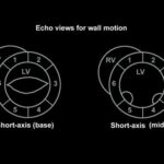 Sol ventrikül duvar segmentleri sonoguide.com