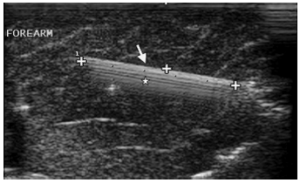 Uzun aks yüksek frekanslı ultrason görüntüsü. Ön kolda hiperekoik 5 cm cam parçası (uzun ok) ve altında ‘yıldız kuyruğu’ işareti (küçük yıldızla işaretlenmiş) görülüyor.