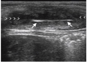 Uzun aks yüksek frekans ultrason görüntüsü. Ön kolda 6 mm tahta parçası (uzun ok), arkasında akustik gölge yok fakat etrafında yumuşak doku absesine bağlı ‘halo’ işareti var (hipoekoik alan, ok başları ile belirtilmiş.) Tahta radyolüsan bir yabancı cisim olduğundan düz grafide bulgu vermez.