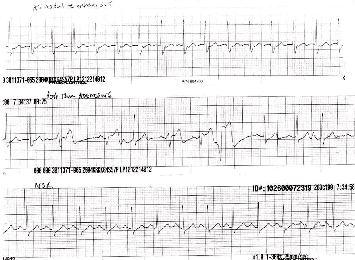 Av Ablation Avnrt Catheter Nodal Why Procedure Tachycardia Reentrant ...