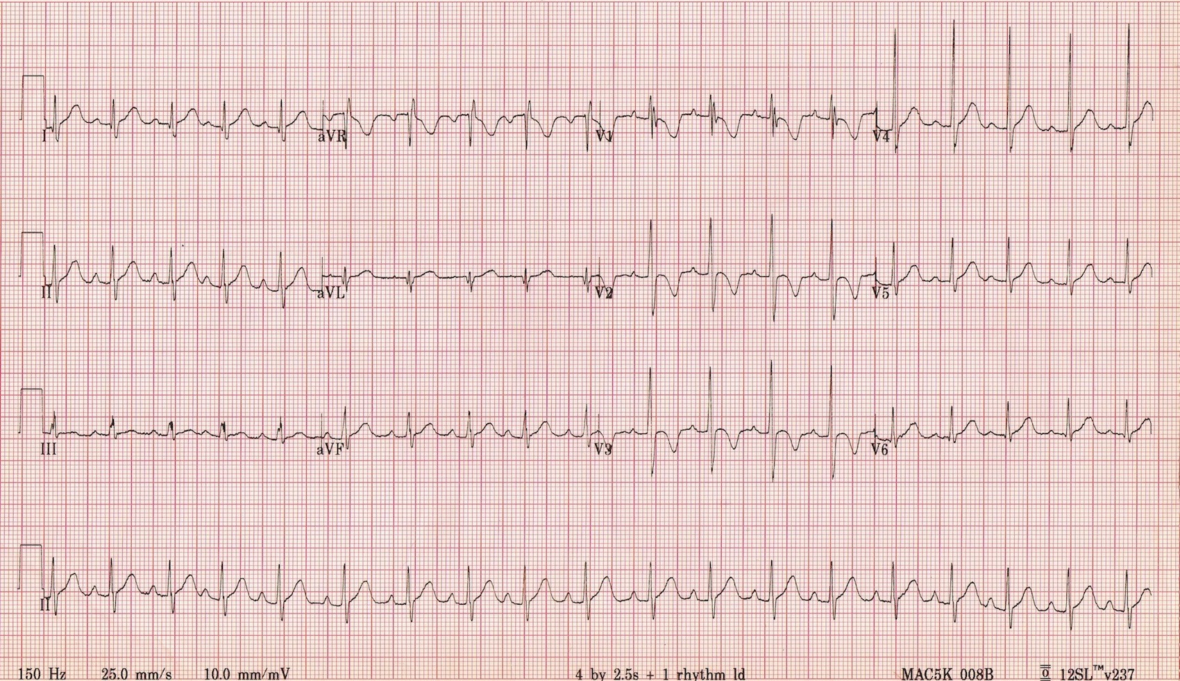 Normal paeds ECG 2 year old boy Acilci Net