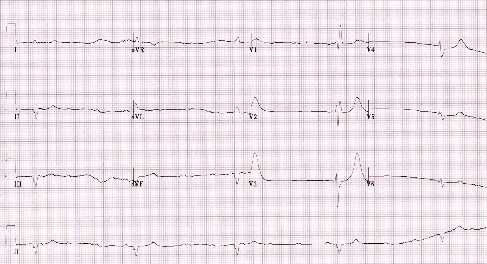 atrioventricular-av-block-gulf-coast-veterinary-cardiology