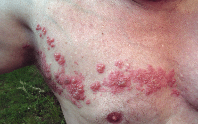 Ülker: Herpes Zoster, Kanıta Dayalı Tedavi Yöntemleri