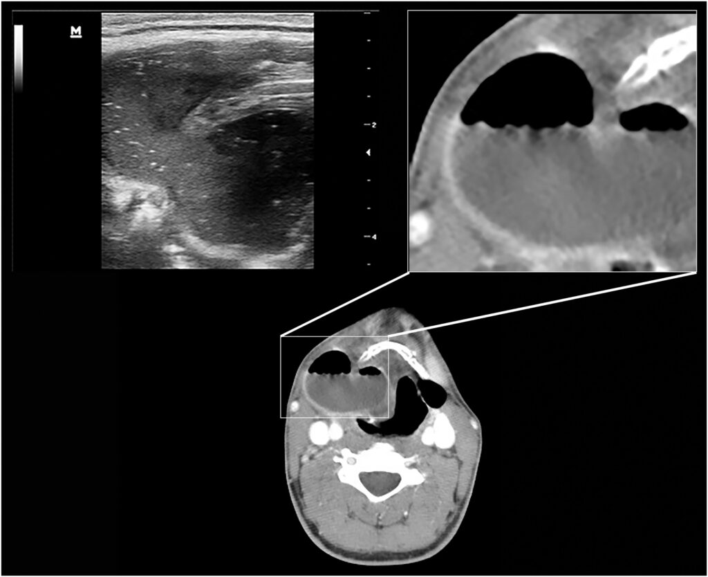 USG ve BT'de sağ submandibular bölgedeki mix tip laringopyoselin seyri. BT görüntülerin aksine, USG'de hava sıvı materyal ile karışmış olarak izlenmektedir. BT'de ayrıca sol tarafta da mix tip laringosel oluşumu raporlanmıştır. Bu kesitte ise laringoselin eksternal bölümü izlenmektedir.