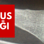 Torus KIRIGI