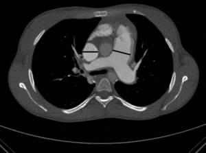 Pulmoner arter çapı, çıkan aortadan geniş.