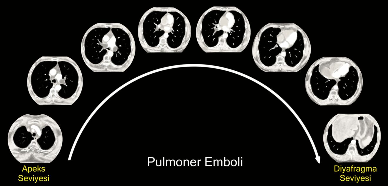 Pulmoner Emboli Yönetimi: Güncel Bir Özet!