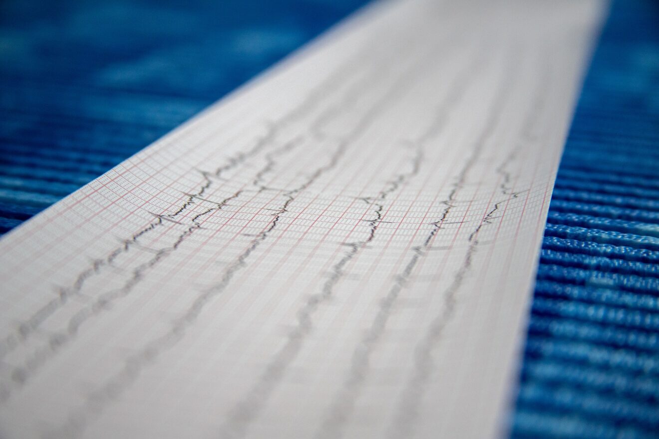 Resüsitasyon Sonrası Erken Çekilen EKG Yanıltıcı mı?