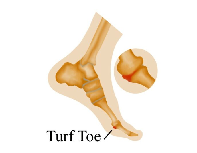 Turf Toe - Acilci.Net