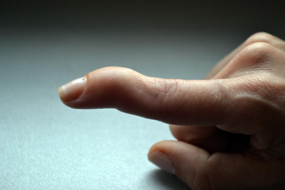 Sporcularda Görülen El Travmaları-Mallet Finger
