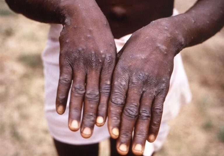 Maymun Çiçeği (MPOX) Enfeksiyonu Tedavisinde Tecovirimat