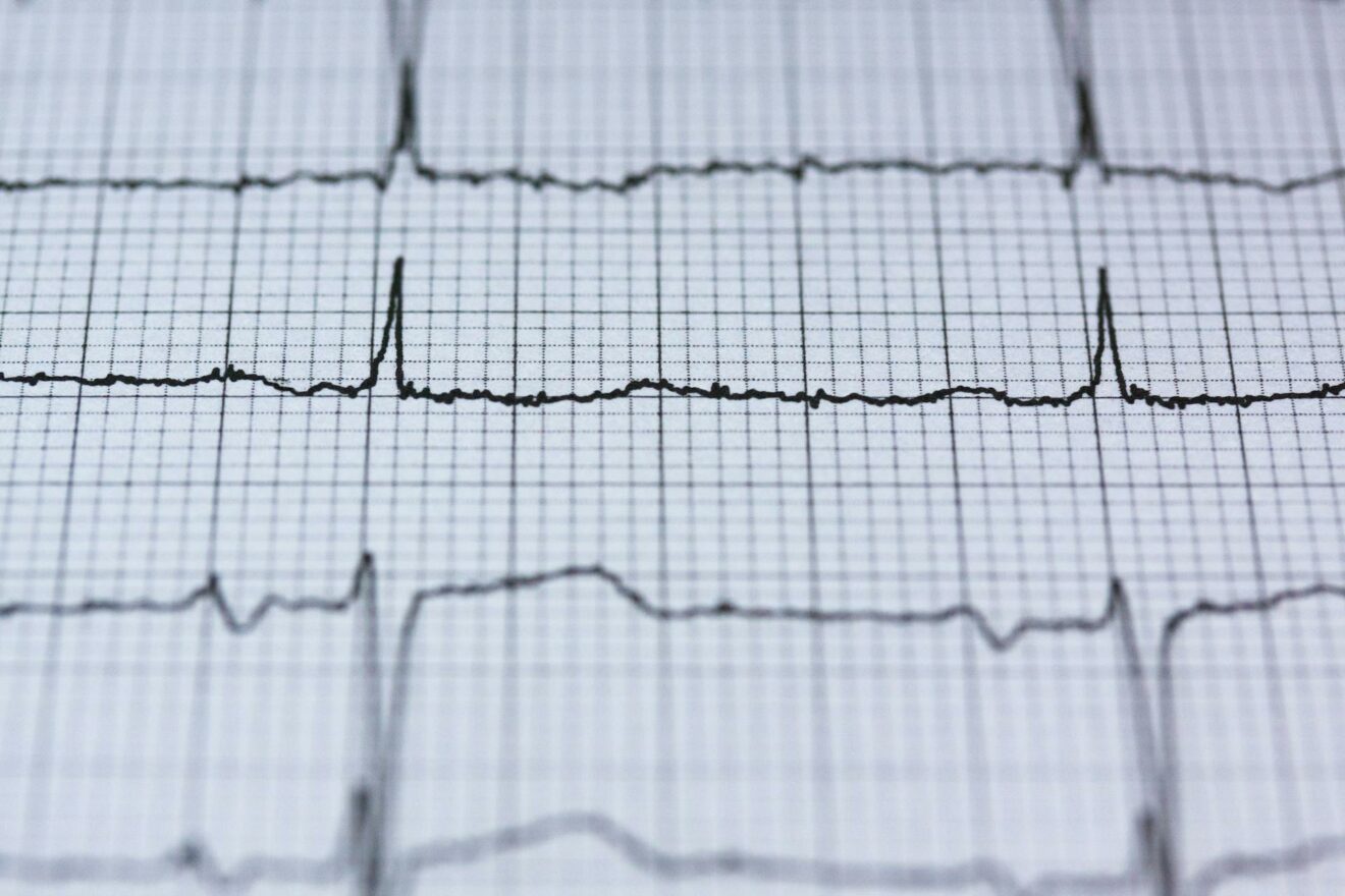 Lewis Derivasyonu: EKG'de Atriyal Aktiviteyi İyileştirmek