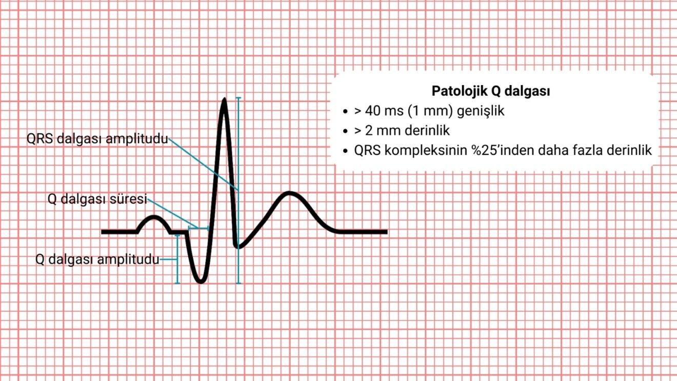 Q Dalgası Doğası, Patolojisi ve Klinik Önemi
