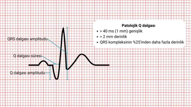 Q Dalgası Doğası, Patolojisi ve Klinik Önemi