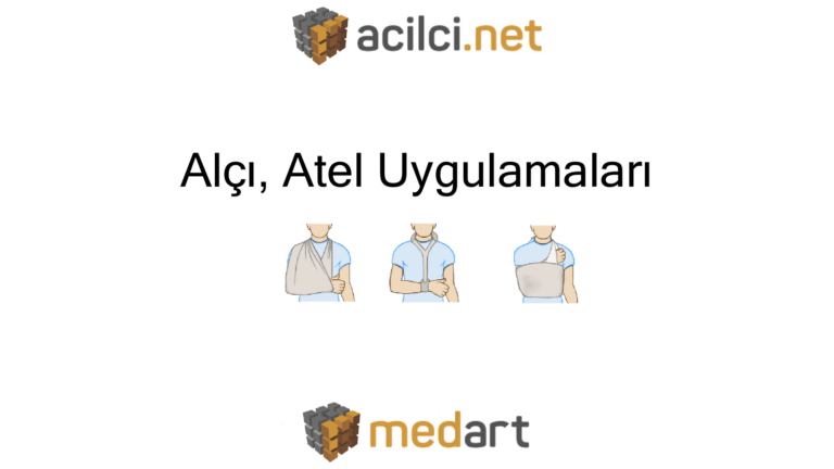 Alçı, Atel Uygulamaları
