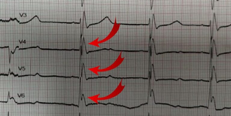 Osborn Dalgası: Hipoterminin EKG’deki İmzası