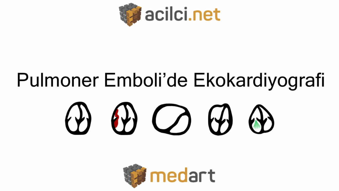 Pulmoner Emboli'de Ekokardiyografi